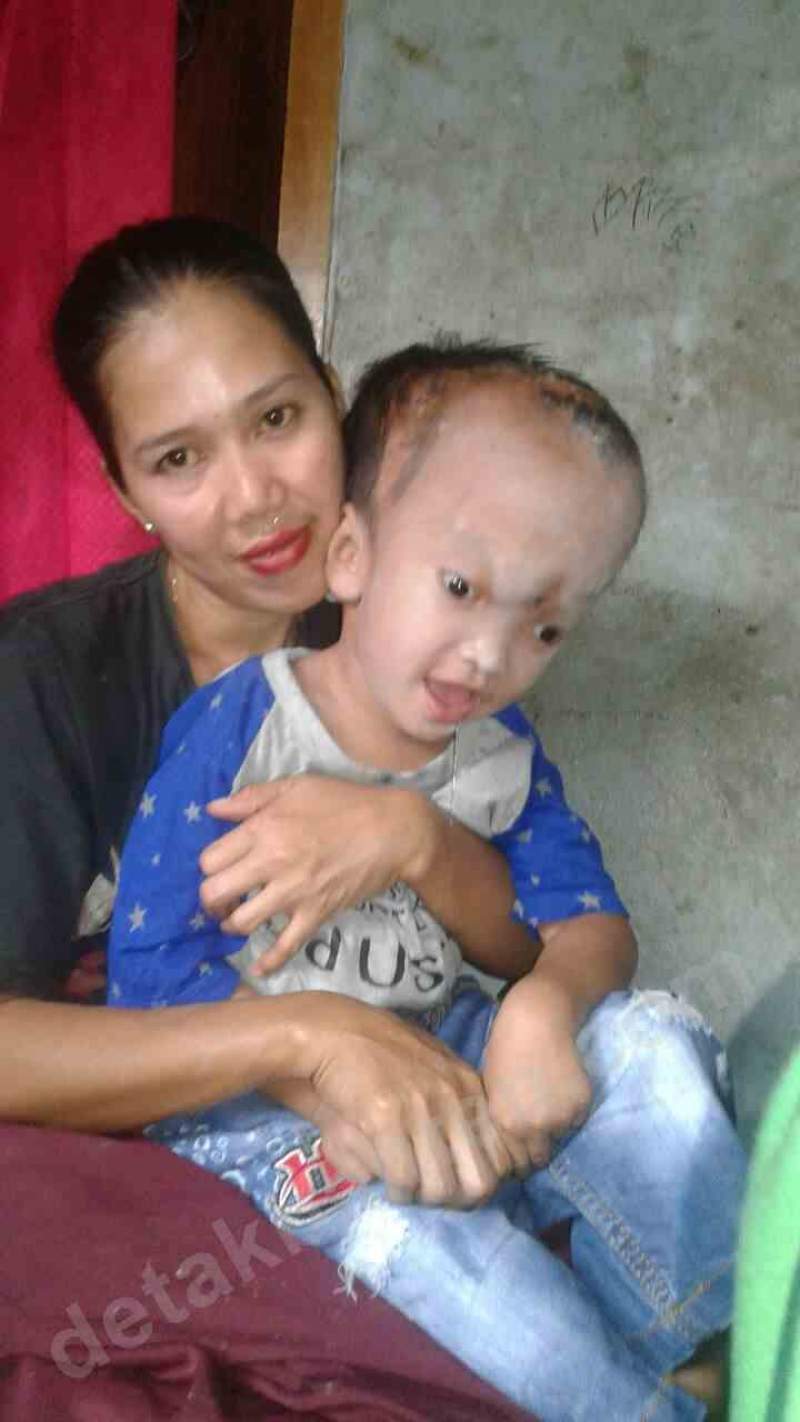 Balita Penderita Hidrosefalus Butuh Uluran Dana