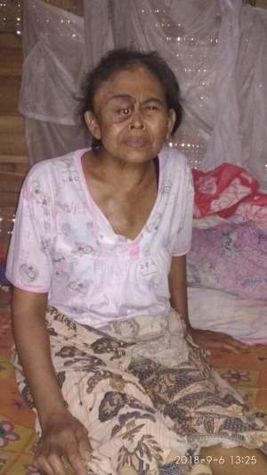 Penderita Kanker di Pandeglang Butuh Bantuan