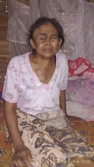 Penderita Kanker di Pandeglang Butuh Bantuan