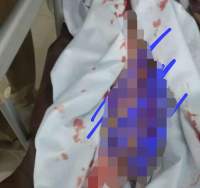 tangan korban yang nyaris hancur.