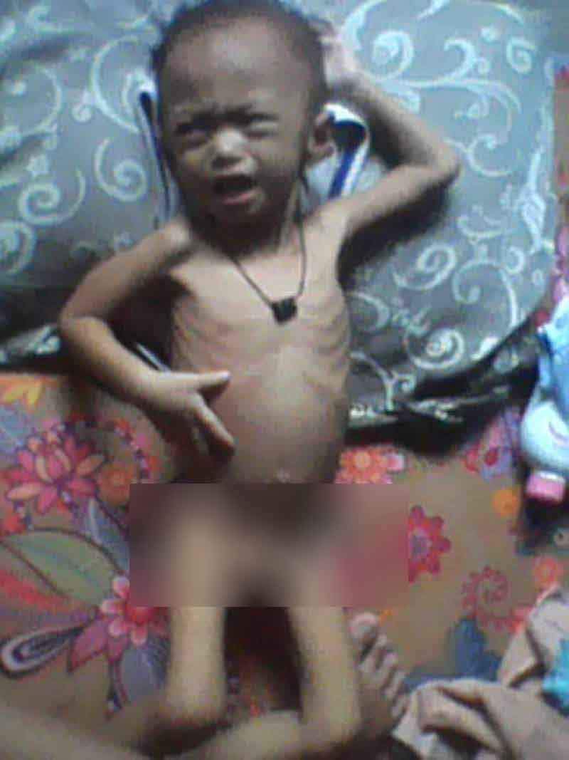 Suhadi (2) penderita gizi buruk di Lebak.