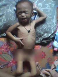 Suhadi (2) penderita gizi buruk di Lebak.