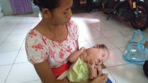 Warga Kota Serang Bayi Derita Tumor Sejak Lahir, Membutuhkan Biaya