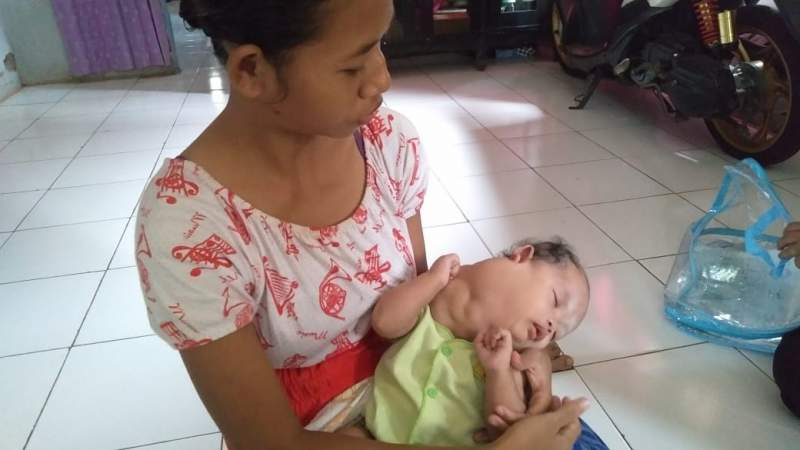 Warga Kota Serang Bayi Derita Tumor Sejak Lahir, Membutuhkan Biaya