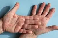 Ilustrasi cacar monyet.