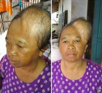 Warga Miskin Sawarna Idap Penyakit Aneh