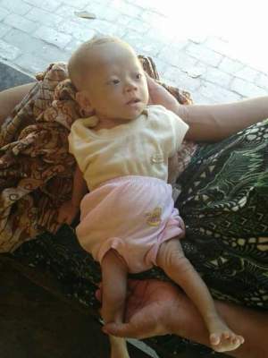 Balita Penderita Bocor Jantung Butuh Penanganan Intensif