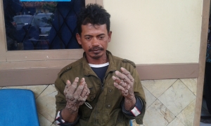 Seorang Nelayan Menderita Penyakit 'Manusia Akar'