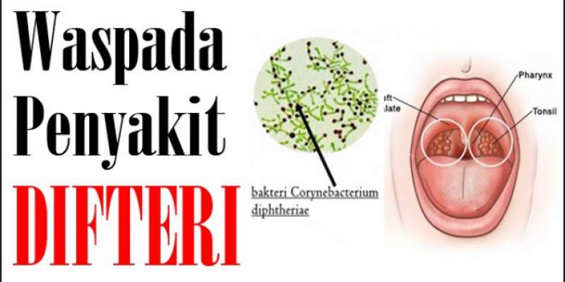 Difteri