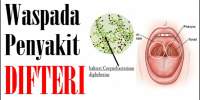 Difteri